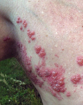 Herpes symptoms in the whole body