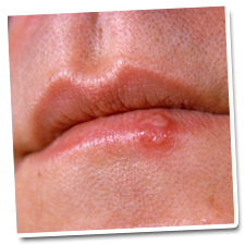 herpes - need treatment and cure